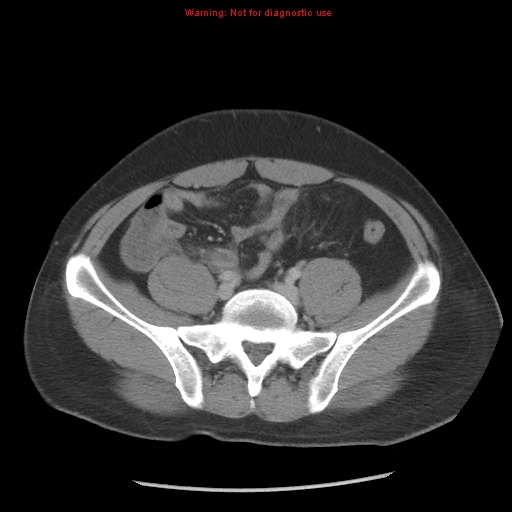 Acute appendicitis (Radiopaedia 10498-10973 Axial C+ portal venous phase 25).jpg