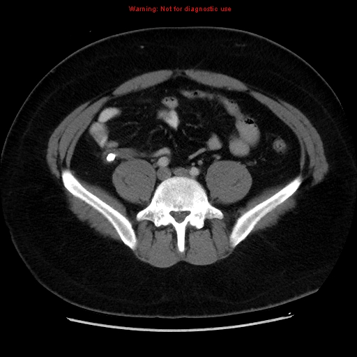 File:Acute appendicitis (Radiopaedia 12326-12607 Axial C+ portal venous phase 24).jpg