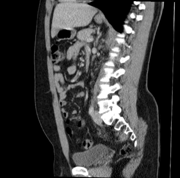 Acute appendicitis (Radiopaedia 38255-40270 Sagittal C+ portal venous phase 48).jpg