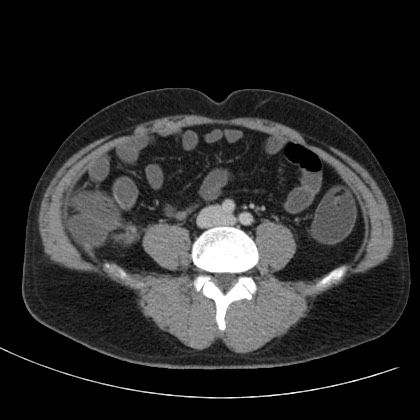 File:Acute appendicitis (Radiopaedia 66513-75790 Axial C+ portal venous phase 53).jpg