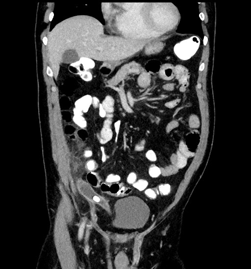 Acute appendicitis (Radiopaedia 77016-88960 Coronal C+ portal venous phase 37).jpg
