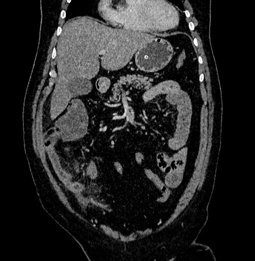 Acute appendicitis (Radiopaedia 79950-93224 Coronal C+ portal venous phase 29).jpg