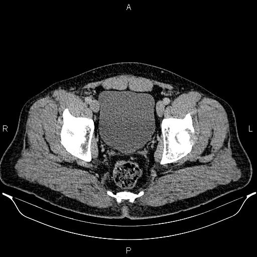 Acute appendicitis (Radiopaedia 84780-100240 Axial C+ portal venous phase 100).jpg