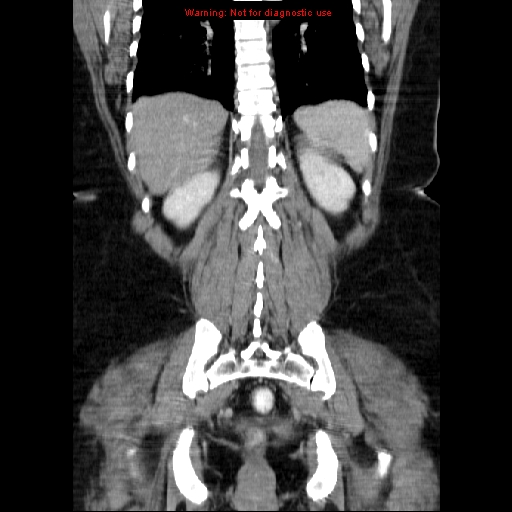 Acute appendicitis complicated by ovarian vein thrombophlebitis (Radiopaedia 16172-15851 Coronal C+ portal venous phase 63).jpg
