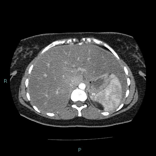 File:Acute bilateral pyelonephritis (Radiopaedia 37146-38881 Axial C+ arterial phase 26).jpg