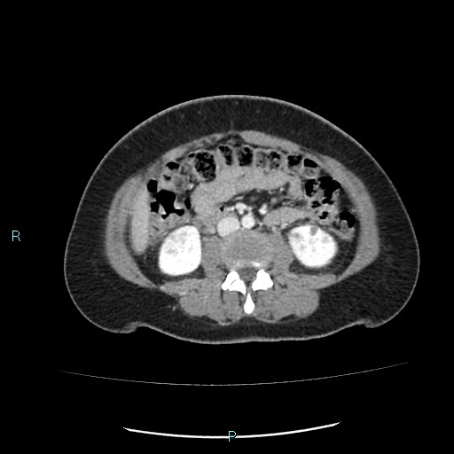 Acute bilateral pyelonephritis (Radiopaedia 37146-38881 Axial C+ portal venous phase 54).jpg