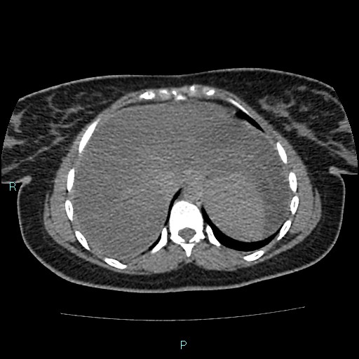 File:Acute bilateral pyelonephritis (Radiopaedia 37146-38881 Axial non-contrast 13).jpg