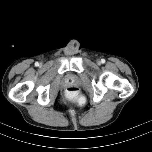 Acute bowel ischemia (Radiopaedia 87695-104114 Axial C+ portal venous phase 86).jpg
