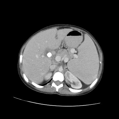 File:Acute calculous cholecystitis in patient with osteopetrosis (Radiopaedia 77871-90159 Axial C+ portal venous phase 31).jpg