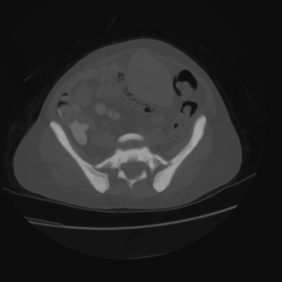 File:Acute calculous cholecystitis in patient with osteopetrosis (Radiopaedia 77871-90159 Axial bone window 36).jpg