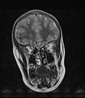 File:Acute cerebellar ataxia (Radiopaedia 61487-69446 Coronal T2 1).jpg