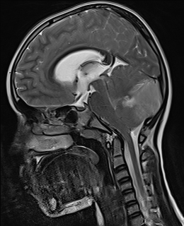 File:Acute cerebellar ataxia (Radiopaedia 61487-69446 Sagittal T2 6).jpg