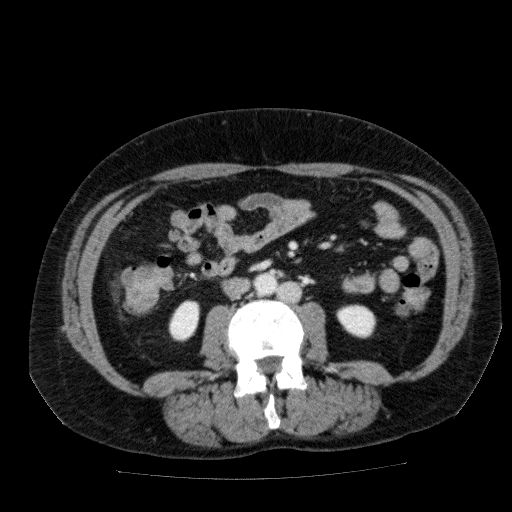 Acute cholecystitis and incidental left sided IVC (Radiopaedia 49352-54459 Axial C+ portal venous phase 82).jpg