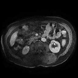 Acute cholecystitis complicated by pylephlebitis (Radiopaedia 65782-74915 Axial arterioportal phase T1 C+ fat sat 91).jpg