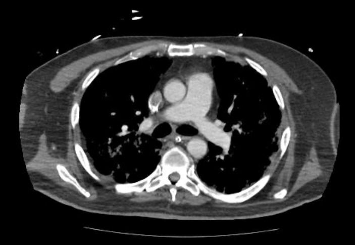 File:Acute cor pulmonale (ultrasound) (Radiopaedia 83508-98818 Axial C+ CTPA 31).jpg