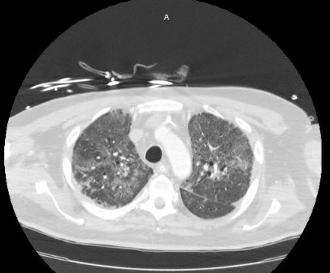 Acute cor pulmonale (ultrasound) (Radiopaedia 83508-98818 Axial lung window 24).jpg