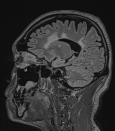 Acute disseminated encephalomyelitis (ADEM)- Anti-NMDA receptor encephalitis (Radiopaedia 54920-61201 Sagittal FLAIR 54).png