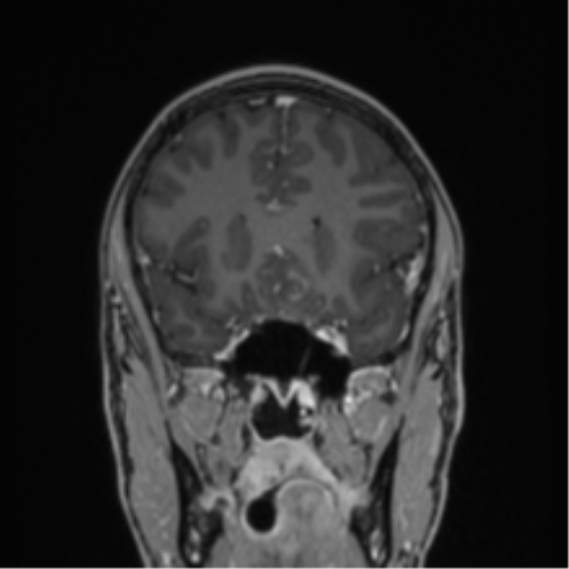 Acute disseminated encephalomyelitis (ADEM) (Radiopaedia 65319-74349 Coronal T1 C+ 39).png