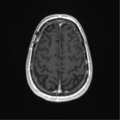 Acute disseminated encephalomyelitis (ADEM) (Radiopaedia 65319-74350 Axial T1 C+ 53).png