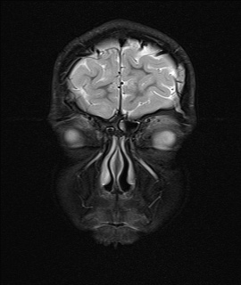 File:Acute disseminating encephalomyelitis with bilateral optic neuritis (Radiopaedia 79676-92886 Coronal STIR 1).jpg