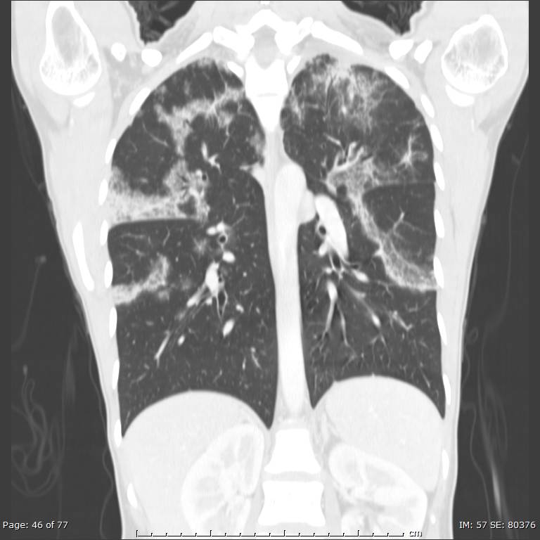 Acute eosinophilic pneumonia (Radiopaedia 48211-53073 Coronal lung window 31).jpg