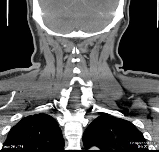 Acute epiglottitis (Radiopaedia 54375-60590 Coronal C+ arterial phase 56).jpg