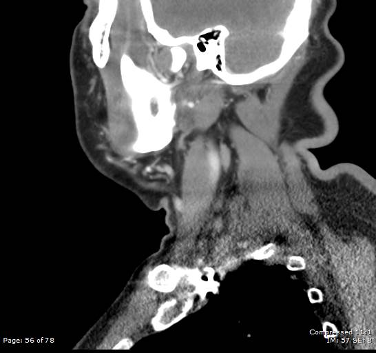 Acute epiglottitis (Radiopaedia 54375-60590 Sagittal C+ arterial phase 56).jpg