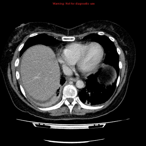File:Acute gangrenous cholecystitis (Radiopaedia 10123-10661 Axial C+ portal venous phase 8).jpg