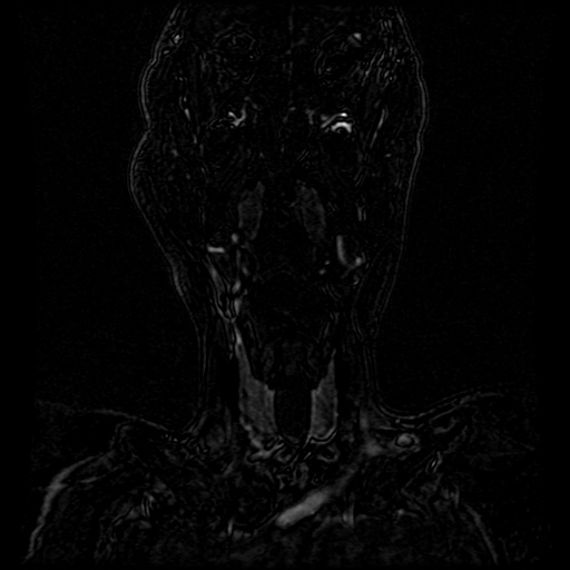 Acute internal carotid artery dissection (Radiopaedia 53541-59632 Coronal MRA 77).jpg