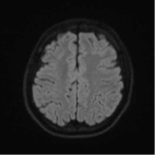 Acute left middle cerebral artery territory infarct with clot retrieval (Radiopaedia 47732-52433 Axial DWI 52).png