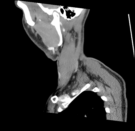 Acute longus colli calcific tendinitis (Radiopaedia 72495-83036 Sagittal C+ arterial phase 57).jpg