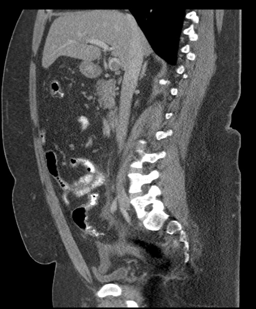 Acute mesenteric venous ischemia (Radiopaedia 46041-50383 Sagittal C+ portal venous phase 50).jpg