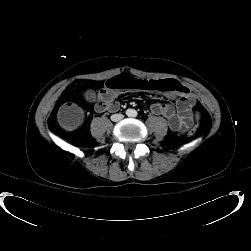 Acute myocardial infarction in CT (Radiopaedia 39947-42415 Axial C+ portal venous phase 80).jpg