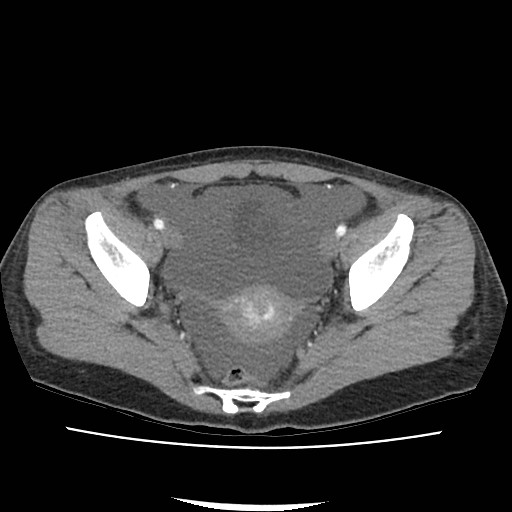 File:Acute myocarditis (Radiopaedia 55988-62613 Axial C+ portal venous phase 69).jpg