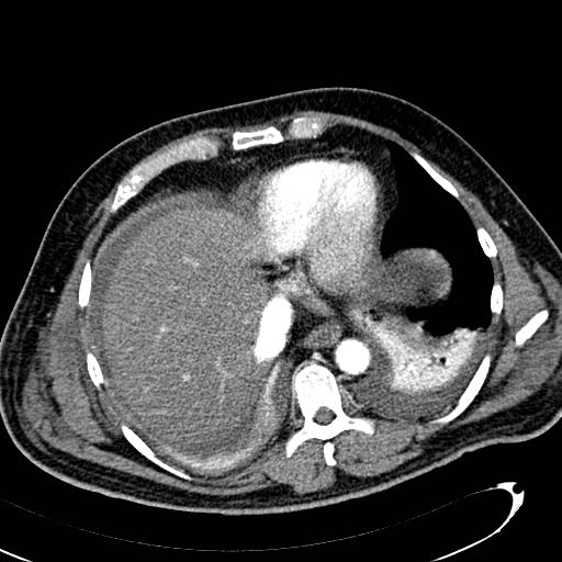 File:Acute pancreatic necrosis (Radiopaedia 13560-13486 Axial C+ portal venous phase 20).jpg