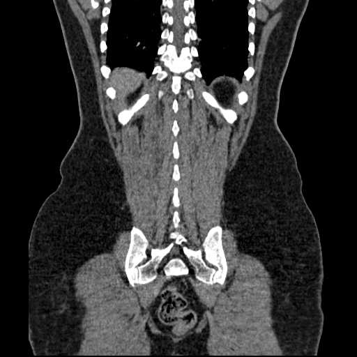 File:Acute pancreatitis (Radiopaedia 20829-20744 Coronal C+ portal venous phase 46).jpg