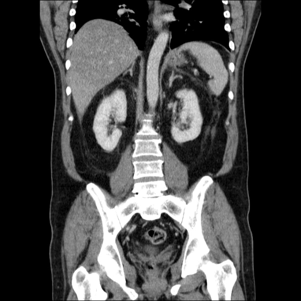 Acute pancreatitis (Radiopaedia 26663-26813 Coronal C+ portal venous phase 42).jpg