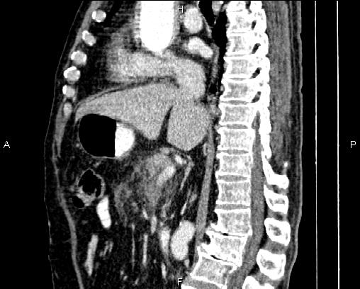 Acute pancreatitis (Radiopaedia 85146-100701 Sagittal C+ portal venous phase 44).jpg