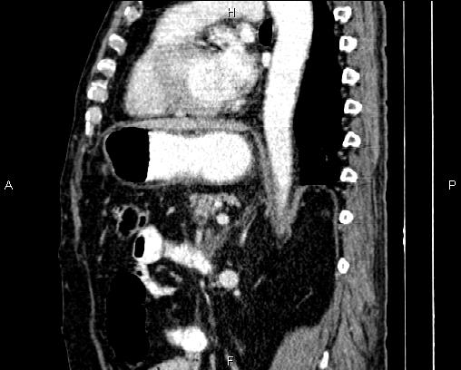 Acute pancreatitis (Radiopaedia 85146-100701 Sagittal C+ portal venous phase 59).jpg