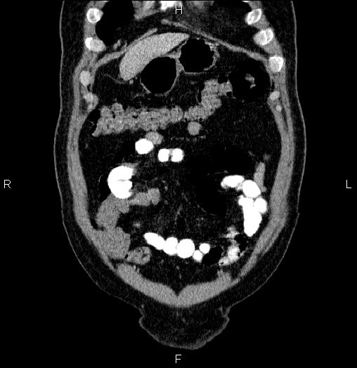 Acute pancreatitis (Radiopaedia 85390-101010 Coronal C+ portal venous phase 8).jpg