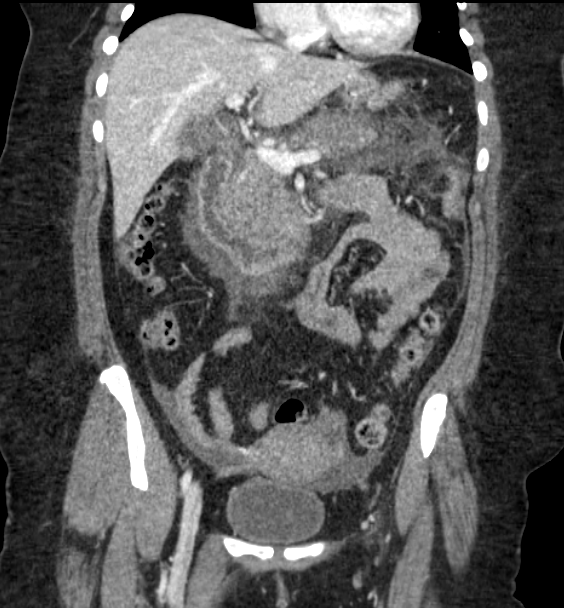 Acute pancreatitis - Balthazar E (Radiopaedia 29016-29377 Coronal C+ portal venous phase 44).png
