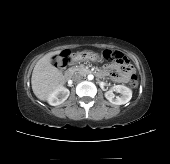 File:Acute pancreatitis - Balthazar E - post ERCP (Radiopaedia 27562-27772 Axial C+ arterial phase 23).png