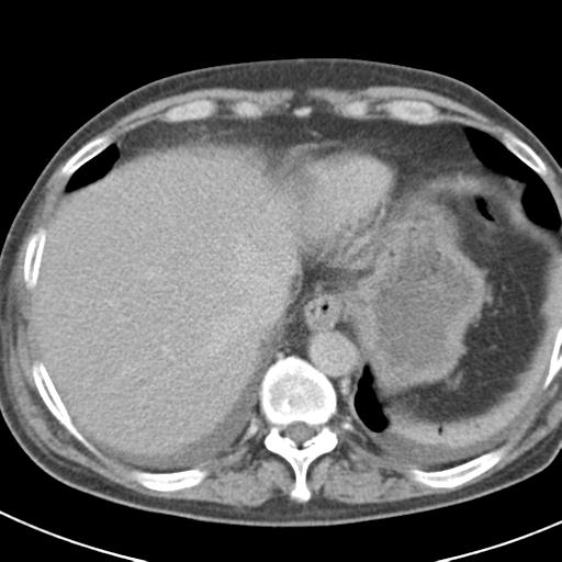 Acute pancreatitis and walled-off necrosis (Radiopaedia 29888-30403 Axial C+ delayed 14).jpg