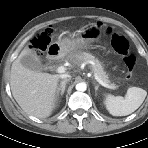 File:Acute pancreatitis and walled-off necrosis (Radiopaedia 29888-30403 Axial C+ portal venous phase 11).jpg