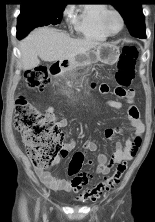 Acute pancreatitis and walled-off necrosis (Radiopaedia 29888-30403 E 19).jpg