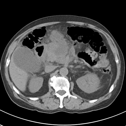 File:Acute pancreatitis and walled-off necrosis (Radiopaedia 29888-30404 Axial non-contrast 28).jpg