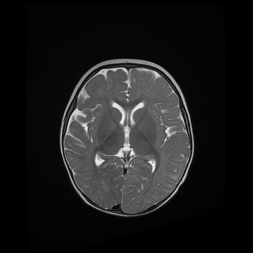 File:Acute phase of hemiconvulsion-hemiplegia epilepsy syndrome (Radiopaedia 29309-29745 Axial T2 12).jpg