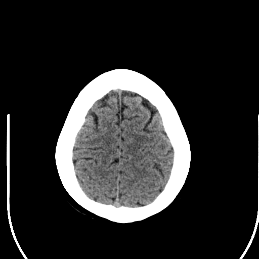 File:Acute pontine infarct from vertebral artery dissection (Radiopaedia 34111-35369 Axial non-contrast 26).png