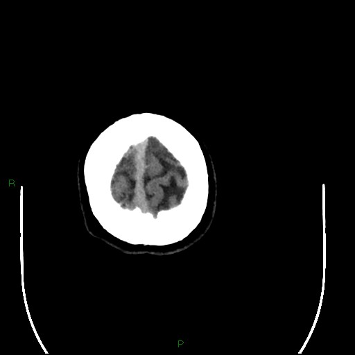 Acute posterior cerebral artery territory infarct (Radiopaedia 79329-92393 Axial non-contrast 106).jpg