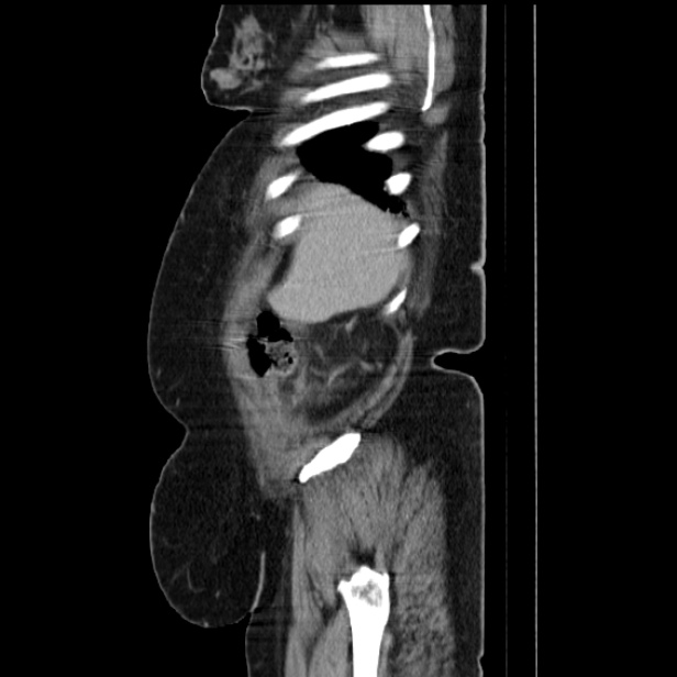 Acute pyelonephritis (Radiopaedia 25657-25837 Sagittal renal parenchymal phase 18).jpg
